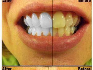 Teeth Whitening PS Action Photo Effects